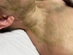 Terapia Enzimática para pieles deshidratadas y acné - Imagen 4