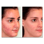 Microdermoabrasión Maiya - Imagen 2